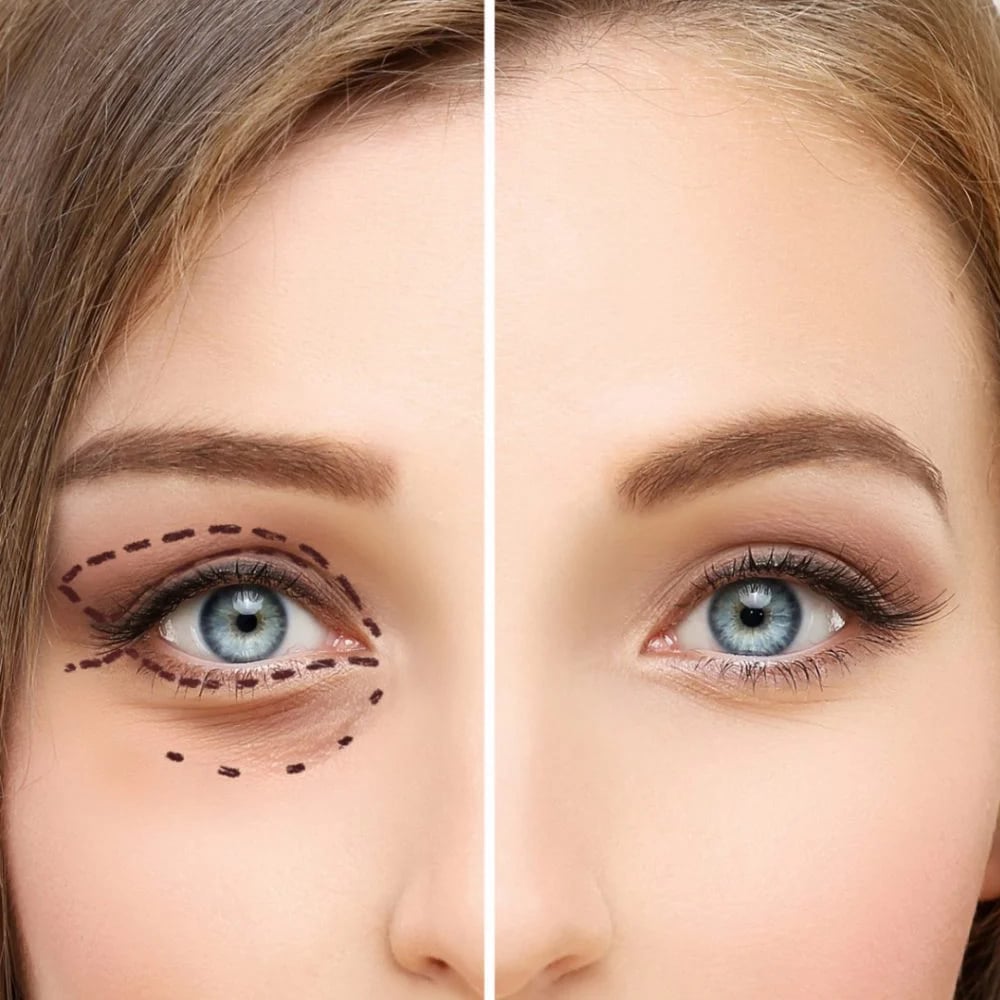 Blefaroplastia